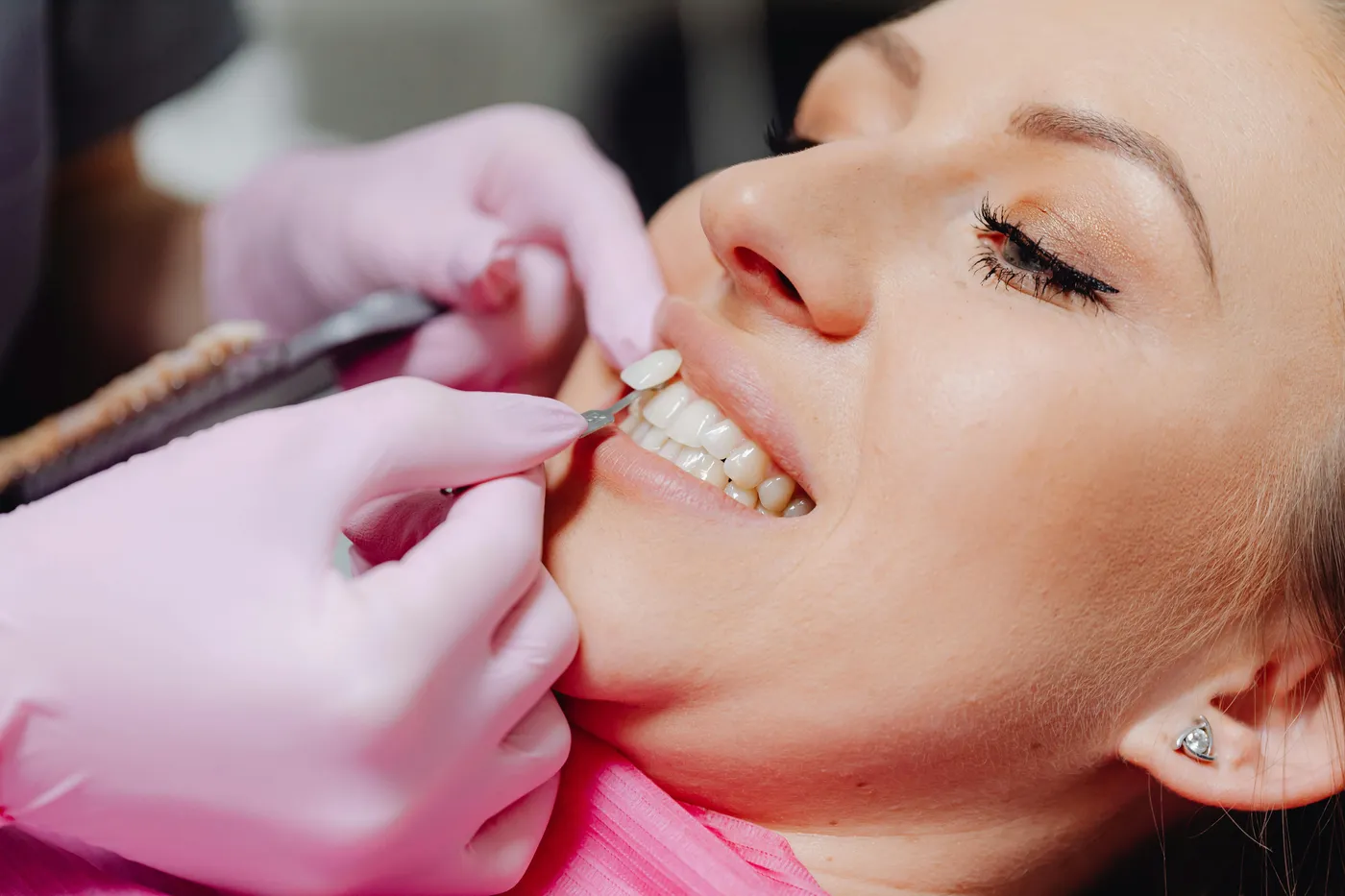 Veneers service